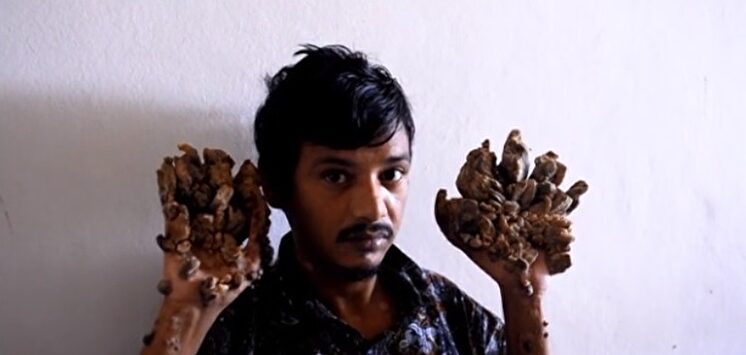 Abul Bajandar, conocido como el 'hombre árbol' | Imagen TV