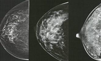 Mamografía | Archivo