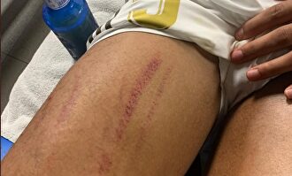 La pierna de Varane. | Instagram