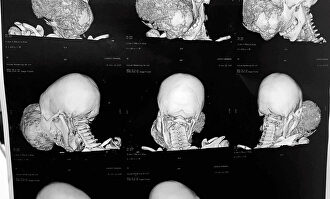 Un TAC del niño antes de ser operado. | EFE