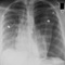 Neumotorax: El neumotórax origina un colapso del pulmón produciendo un fuerte dolor. | Wikipedia/ CC/ Clinical Cases
