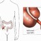 Apendicitis y la peritonitis: La apendicitis y la peritonitis consisten en la inflamación del apéndice y del peritoneo, la membrana que recubre las paredes del abdomen y la superficie de las vísceras digestivas. Son muy dolorosas y requieren una intervención quirúrgica.| Corbis