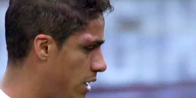 Varane Sustituido En Ipurua Por Un Golpe En La Cabeza Libertad Digital