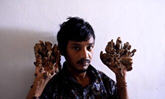 Abul Bajandar, conocido como el 'hombre árbol' |  Imagen TV