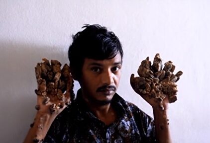 Abul Bajandar, conocido como el 'hombre árbol' |  Imagen TV