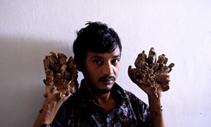 Abul Bajandar, conocido como el 'hombre árbol' |  Imagen TV