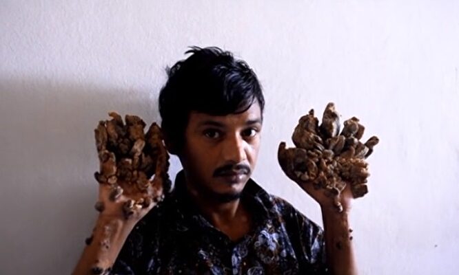 Abul Bajandar, conocido como el 'hombre árbol' |  Imagen TV