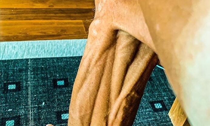 Así luce la pierna del veterano Janez Brajkovic |  Instagram