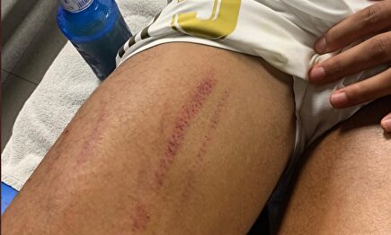 La pierna de Varane. |  Instagram