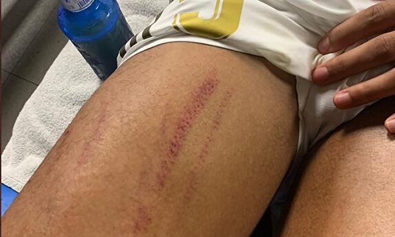 La pierna de Varane. |  Instagram