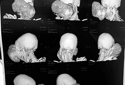 Un TAC del niño antes de ser operado. |  EFE