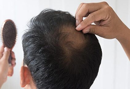 Razones para injertarse pelo |  Pixabay