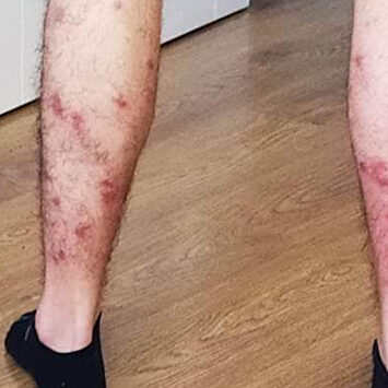 Las moscas negras se ensañaron con el deportista | Twitter @rcbenitez