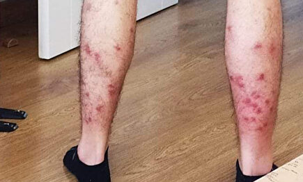 Las moscas negras se ensañaron con el deportista | Twitter @rcbenitez