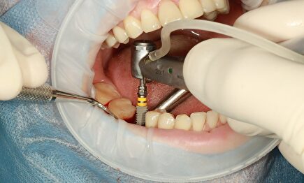 Así se coloca un implante dental. | Pixabay