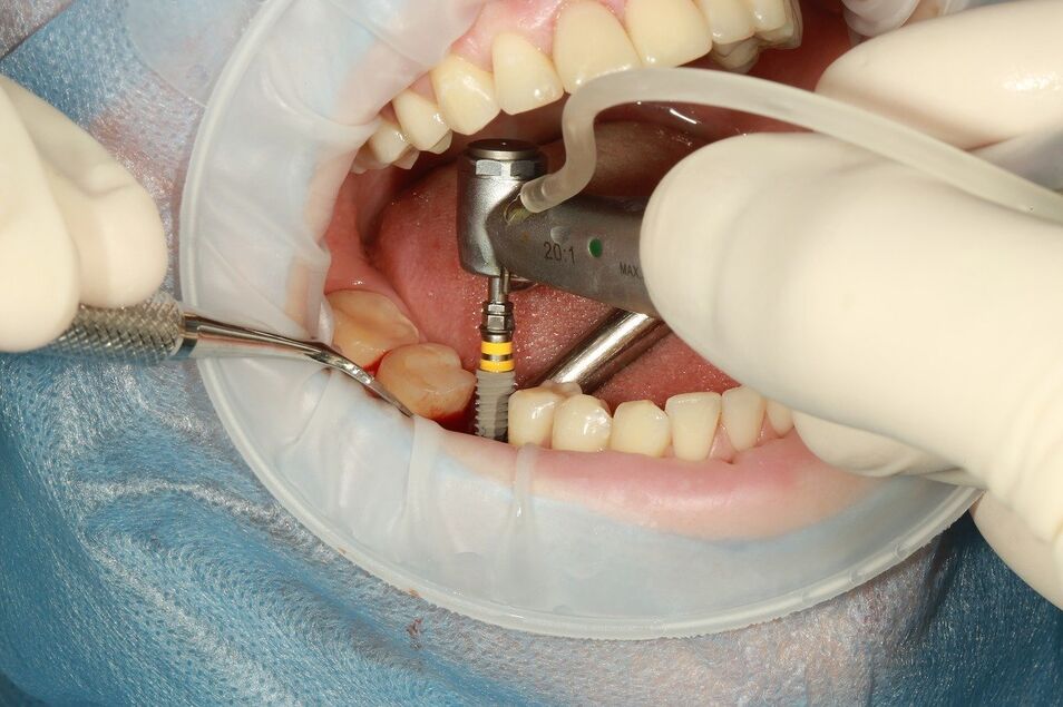 Todo sobre los implantes dentales guía definitiva y beneficios