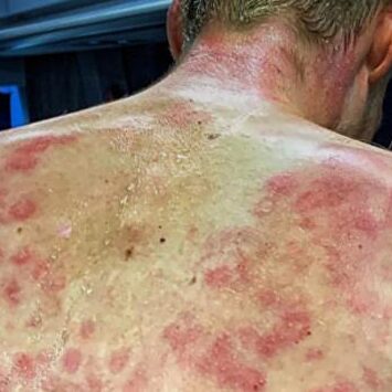 Así quedó la espalda del ciclista belga Tim Declercq tras la tormenta de granizo | Instagram