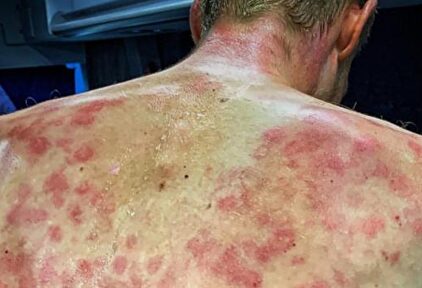 Así quedó la espalda del ciclista belga Tim Declercq tras la tormenta de granizo | Instagram