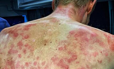 Así quedó la espalda del ciclista belga Tim Declercq tras la tormenta de granizo | Instagram