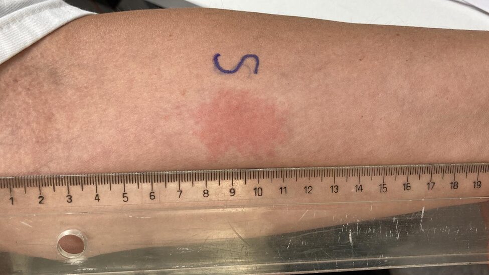 The Spanish test that allows to measure cellular immunity and would