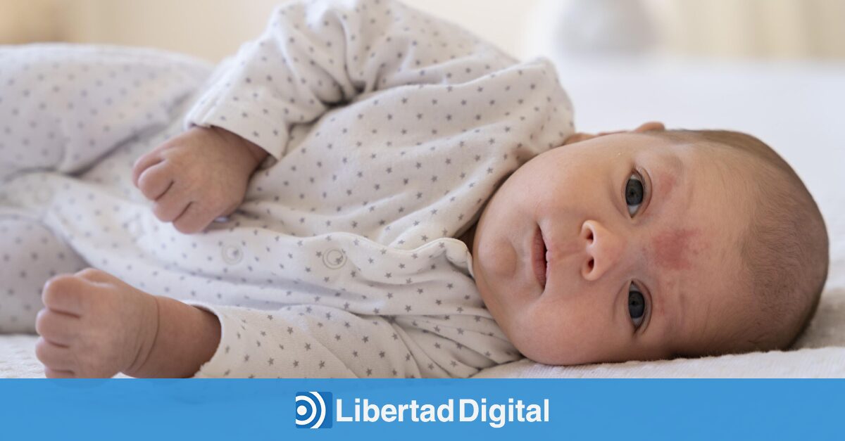 El eccema infantil podría originarse en el útero por el estrés materno, según un nuevo estudio