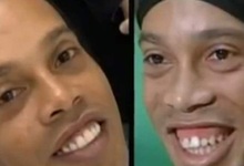 El antes y el despus en la sonrisa de Ronaldinho. | Globo TV
