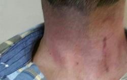 As qued el cuello de la vctima tras el ataque | ASEXTRA