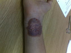 Reaccin a un tatuaje no permanente del Che Guevara. |  Royal Preston Hospital