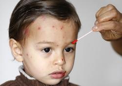 Un niño con varicela | Corbis