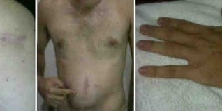 Heridas sufridas por Andrés Ayala durante los intentos de asesinato que ha sufrido en prisión | AA/LD