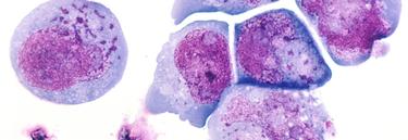 Clulas cancergenas | Archivo