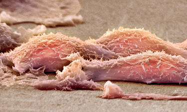 Clulas cancergenas pertenecientes a un sarcoma. | Cordon Press
