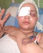 Estudiante saharaui que perdi un ojo por un porra